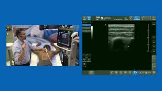 MTP Midpoint between Transverse process amp Pleura Block  aka InterTransverse Plane ITP Block [upl. by Elimaj434]