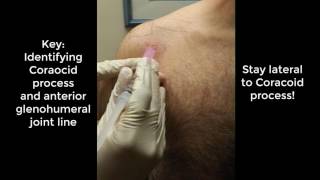 Glenohumeral Shoulder Injection [upl. by Nolyarb]