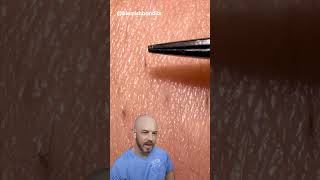 These ingrown hair pulls are super satisfying credit blemishbandits on TT doctor satisfying [upl. by Ahsieki]