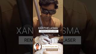 Xanthelasma Removal by CO2 Laser  Fat deposit removal treatment xanthelasma shortvideo skincare [upl. by Magocsi]