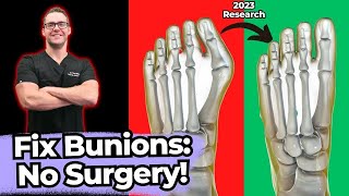 TOP 13 Ways to Shrink Bunions Naturally 1 HUGE SECRET [upl. by Nehepts]