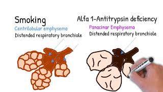 Emphysema  simply explained centrilobular and panacinar emphysema [upl. by Lahpos]