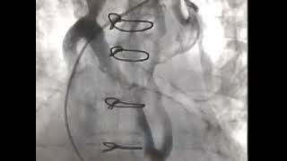 Subclavian venogram before pacemaker implantation [upl. by Luo]