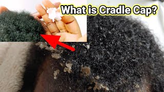 Should i be worried for my baby Common Questions About Cradle Cap in Babies [upl. by Tuhn689]