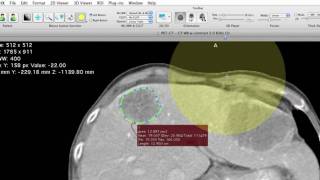 ROI Segmentation with aycan workstation former OsiriX PRO [upl. by Kwang]