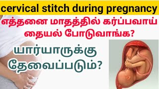 cervix stitches during pregnancy in tamil  cervical stitch in pregnancy tamil  cervical cerclage [upl. by Obadias]