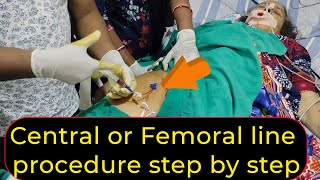 Central or Femoral Line Procedure Step By Step  Dr Subodh SKP [upl. by Hcirdla]