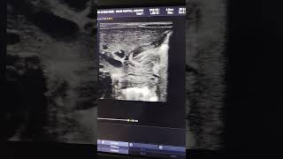 Congenital hypertrophic pyloric stenosis in neonates ultrasoundscans baby [upl. by Mukul]