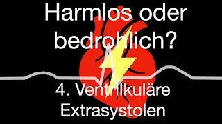 Herzrhythmusstörungen zwischen harmlos oder bedrohlich 4 ventrikuläre Extraschläge [upl. by Tinaret17]