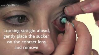 GP contact lens removal with sucker [upl. by Andeee]