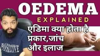 एडिमा क्या होता है कितने प्रकार का ओर इलाज  What Is Oedema In Hindi [upl. by Benioff]