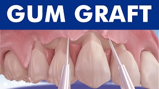 Gum graft  Coronally advanced flap  Receding gums treatment © [upl. by Dud]