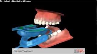 Preventive  Fluoride Treatment  Dentist Ottawa [upl. by Ruhl]