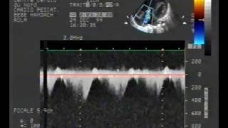 pulmonary hypertension 24 asd tricuspid regurgitation [upl. by Philps]