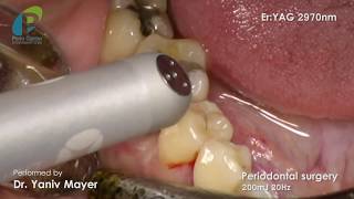 Various treatment applications with laser ErYAG Dr Yaniv Mayer Periodontist [upl. by Hayarahs]