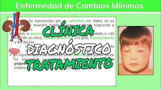 ⚕️🩺 Glomerulopatías ENFERMEDAD DE CAMBIOS MÍNIMOS Síntomas Diagnóstico y Tratamiento [upl. by Kcirdorb]