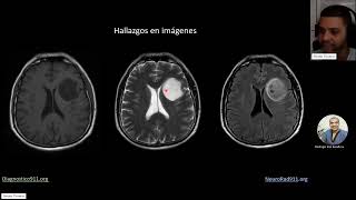 Caso Glioma IDH mutante Astrocitoma G2 [upl. by Leik]