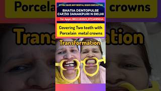 magical transformation of front teeth without Extraction with porcelain crowns [upl. by Mozelle765]