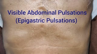 Clinical Examination Visible Epigastric Pulsations [upl. by Azzil83]