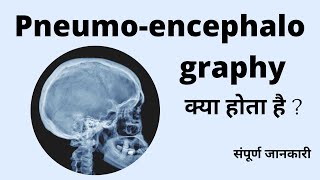 Pneumoencephalography Radiological procedure Air study PEG Study क्या होता है  संपूर्ण जानकारी [upl. by Egnalos]