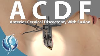 Anterior Cervical Discectomy and Fusion [upl. by Moses]