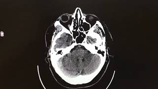TC cerebrale in paziente con emilato destro [upl. by Dorian]