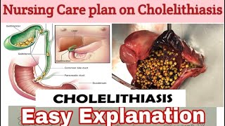 Nursing care plan on Cholelithiasis NCP on CholelithiasisNursing process with nursing diagnosis [upl. by Ahselaf681]