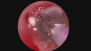 Endoscopic Treatment Airway Stenosis [upl. by Onitselec]