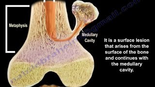 Osteochondroma  solitary and multiple  Everything You Need To Know  Dr Nabil Ebraheim [upl. by Hopkins243]