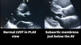 Subaortic membrane stenosis [upl. by Betz14]