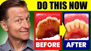 Natural Solution for Plaque Cavities and Gingivitis [upl. by Adlesirk]