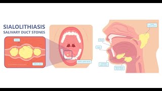 Why formation of calculus  Sialolithiasis is more common in submandibular than in parotid glands [upl. by Kutzer]