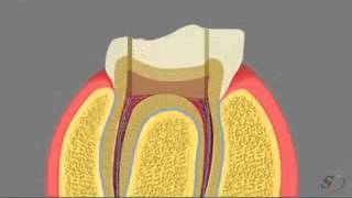 pulpotomia [upl. by Rizas]