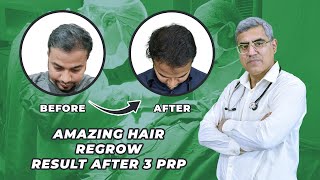 PRP Amazing Result after 3 Months  PRP Therapy for Hair Fall  PRP Treatment stop hair fall [upl. by Hayley]