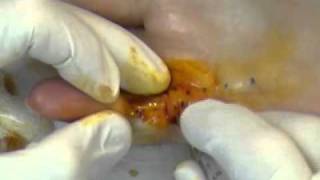 Needle Aponeurotomy for Dupuytrens PIP joint contracture [upl. by George557]