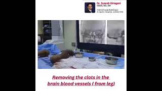 Thrombectomy for Stroke Dr Suresh Giragani’s LifeSaving Procedure Explained [upl. by Ilonka]