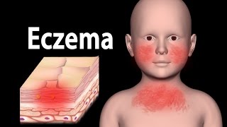 Eczema Animation [upl. by Gurolinick]