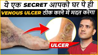 How To Treat Veins Ulcer In Leg At Home  Dr Gaurav Gangwani Interventional Radiologist [upl. by Elbring]