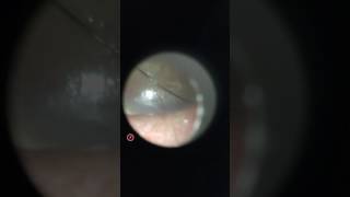 Small Ruptured Tympanic Membrane Right perforated ear drum [upl. by Afatsuom]