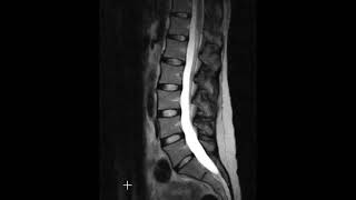 Lumbar spine disc herniations [upl. by Nae942]