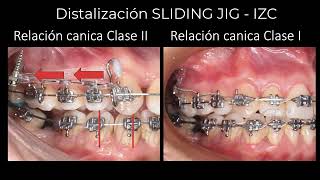 Sliding Jig  IZC Distalización Ortodoncia [upl. by Ecille]