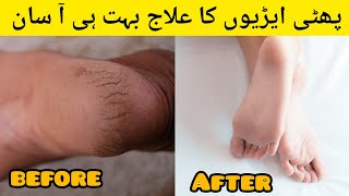 Crack Heel RemedyRemove Dry And Dead Skin From Hand amp Feet  Best FormulaHoori hacks and Tips [upl. by Naltiac218]