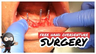 Freehand Overdenture Surgery How to lineup your angles without a guide [upl. by Childs]