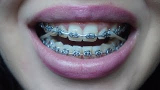 BracesOrtho update Closeup elastics gone wrong and more [upl. by Suirrad]