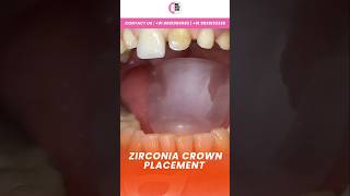 Before and After Zirconium Crowns  ZirconiaCrown BestDentistKolkata HealthySmile [upl. by Znerol493]