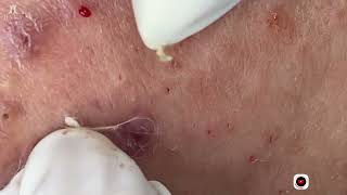 Big Cystic Acne Blackheads Extraction Blackheads amp Milia Whiteheads Removal Pimple Popping [upl. by Attiuqal]