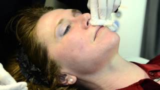 Dermapen Treatment by Cosmetic Laser MD [upl. by Ryann430]