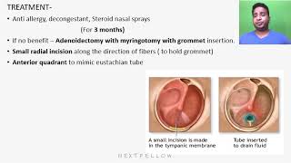 ENT Non Suppurative otitis media concept for NEETPGFMGEINICETNEXT [upl. by Dyl]