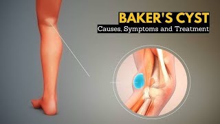 Bakers cyst physio doctor viralvideo kneepain kneepainrelief kneecare aiims orthopedics [upl. by Arednaxela455]