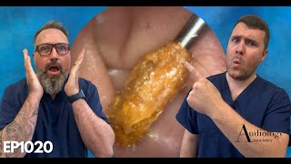 EAR WAX PLUG REMOVAL EAR CANAL CHOLESTEOTOMA AND OPINION ON THE RAI HOOK  EP1020 [upl. by Hudnut]